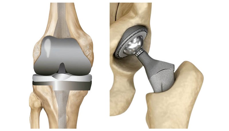 Best Joint Replacement Hospital in Belagavi Karnataka